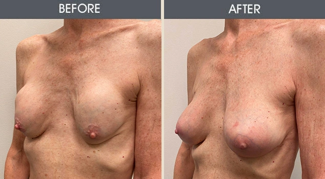 Real patient results in New York, NY Performed by Darrick E. Antell MD, FACS