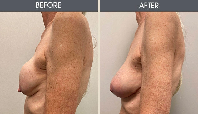 Real patient results in New York, NY Performed by Darrick E. Antell MD, FACS