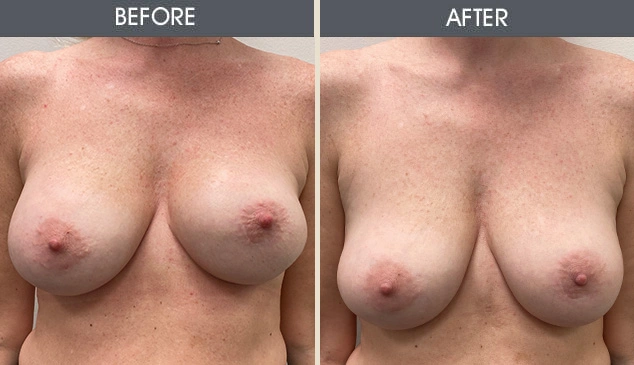 Real patient results in New York, NY Performed by Darrick E. Antell MD, FACS