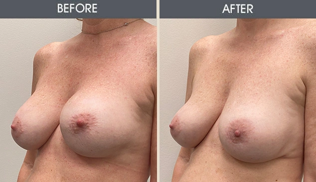 Real patient results in New York, NY Performed by Darrick E. Antell MD, FACS