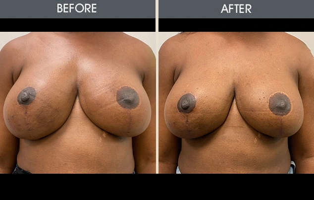 Real patient results in New York, NY Performed by Darrick E. Antell MD, FACS
