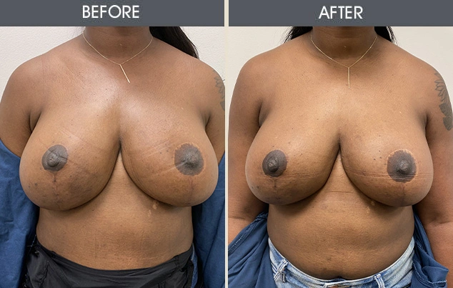 Real patient results in New York, NY Performed by Darrick E. Antell MD, FACS