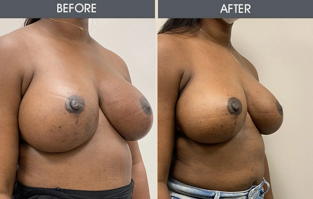 Real patient results in New York, NY Performed by Darrick E. Antell MD, FACS