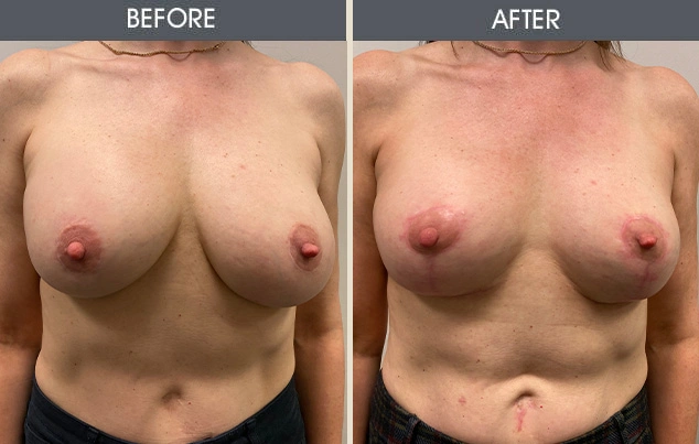 Real patient results in New York, NY Performed by Darrick E. Antell MD, FACS