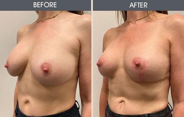 Real patient results in New York, NY Performed by Darrick E. Antell MD, FACS