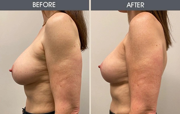 Real patient results in New York, NY Performed by Darrick E. Antell MD, FACS