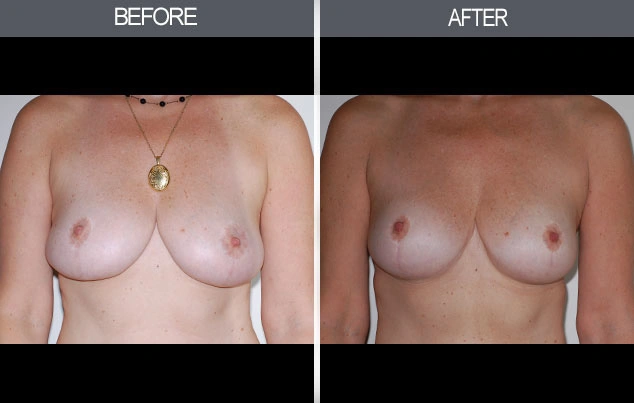 Real patient results in New York, NY Performed by Darrick E. Antell MD, FACS