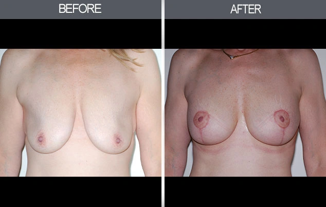 Real patient results in New York, NY Performed by Darrick E. Antell MD, FACS