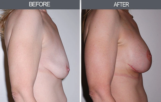 Real patient results in New York, NY Performed by Darrick E. Antell MD, FACS