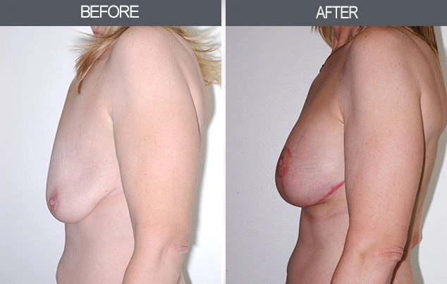 Real patient results in New York, NY Performed by Darrick E. Antell MD, FACS