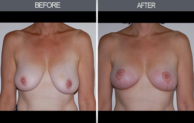 Real patient results in New York, NY Performed by Darrick E. Antell MD, FACS
