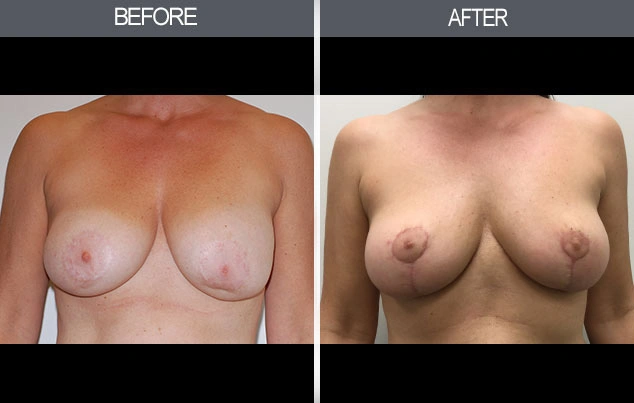 Real patient results in New York, NY Performed by Darrick E. Antell MD, FACS