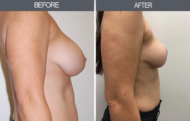 Real patient results in New York, NY Performed by Darrick E. Antell MD, FACS