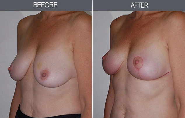 Real patient results in New York, NY Performed by Darrick E. Antell MD, FACS