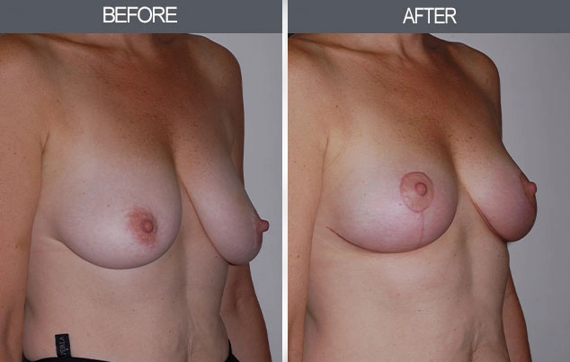 Real patient results in New York, NY Performed by Darrick E. Antell MD, FACS