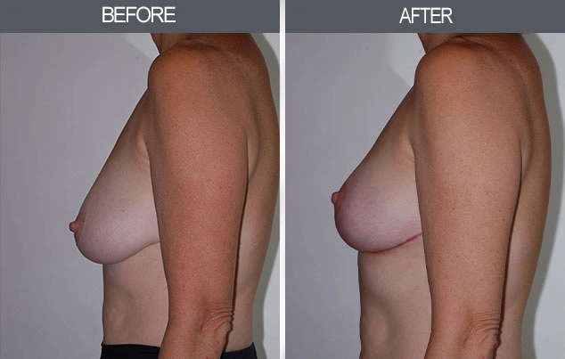 Real patient results in New York, NY Performed by Darrick E. Antell MD, FACS