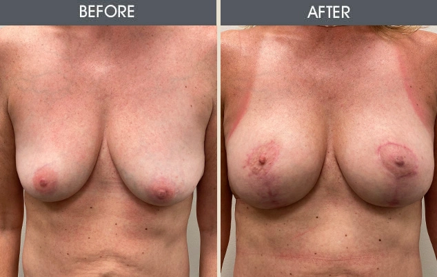 Real patient results in New York, NY Performed by Darrick E. Antell MD, FACS