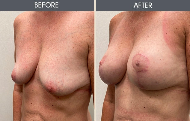 Real patient results in New York, NY Performed by Darrick E. Antell MD, FACS