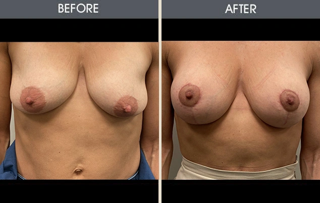 Real patient results in New York, NY Performed by Darrick E. Antell MD, FACS