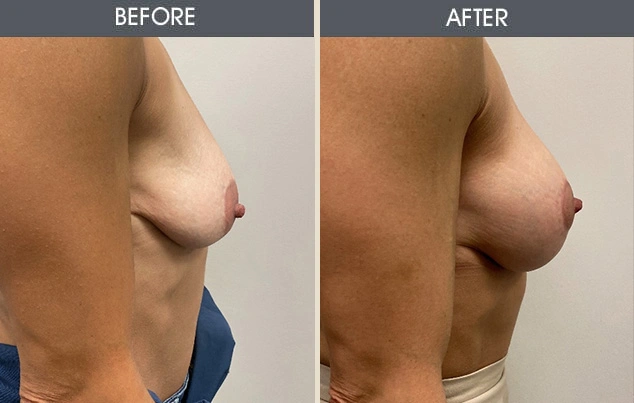 Real patient results in New York, NY Performed by Darrick E. Antell MD, FACS