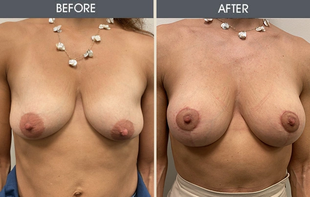 Real patient results in New York, NY Performed by Darrick E. Antell MD, FACS