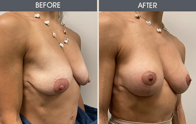 Real patient results in New York, NY Performed by Darrick E. Antell MD, FACS