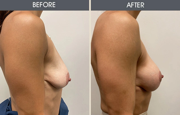 Real patient results in New York, NY Performed by Darrick E. Antell MD, FACS
