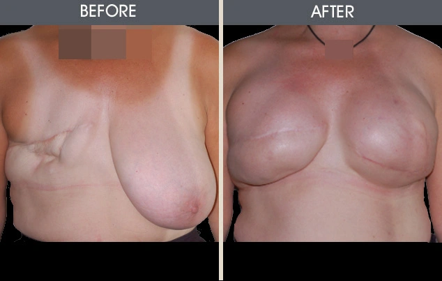 Real patient results in New York, NY Performed by Darrick E. Antell MD, FACS