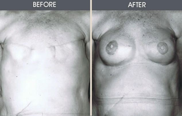 Real patient results in New York, NY Performed by Darrick E. Antell MD, FACS