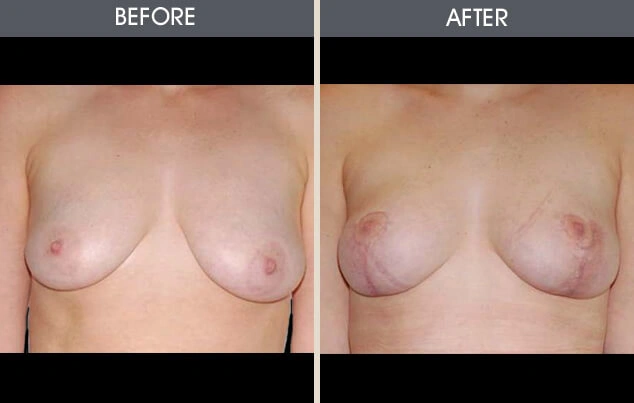 Real patient results in New York, NY Performed by Darrick E. Antell MD, FACS