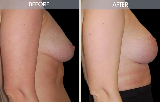 Real patient results in New York, NY Performed by Darrick E. Antell MD, FACS