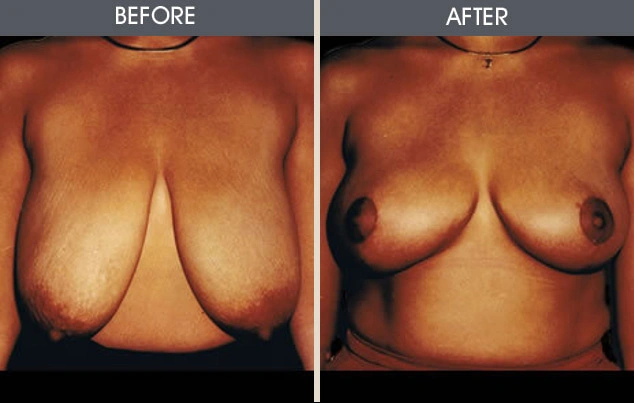 Real patient results in New York, NY Performed by Darrick E. Antell MD, FACS