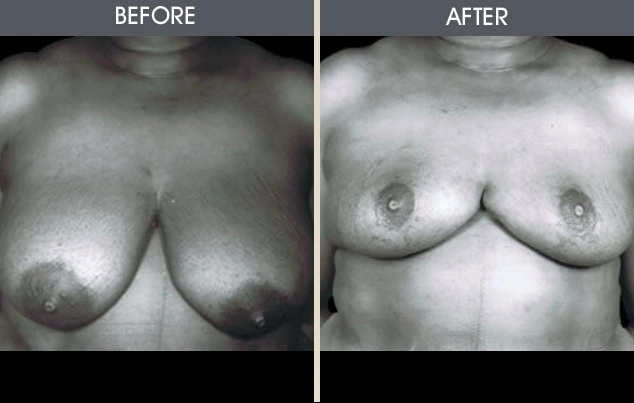 Real patient results in New York, NY Performed by Darrick E. Antell MD, FACS