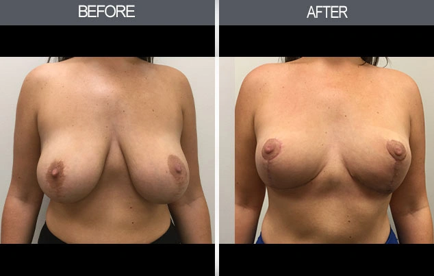 Real patient results in New York, NY Performed by Darrick E. Antell MD, FACS