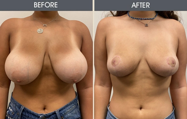 Real patient results in New York, NY Performed by Darrick E. Antell MD, FACS