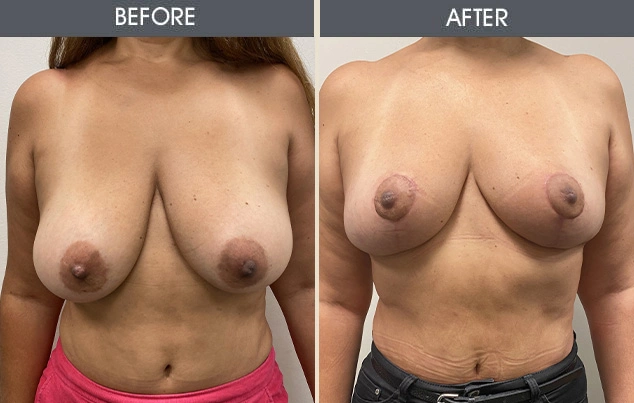 Real patient results in New York, NY Performed by Darrick E. Antell MD, FACS