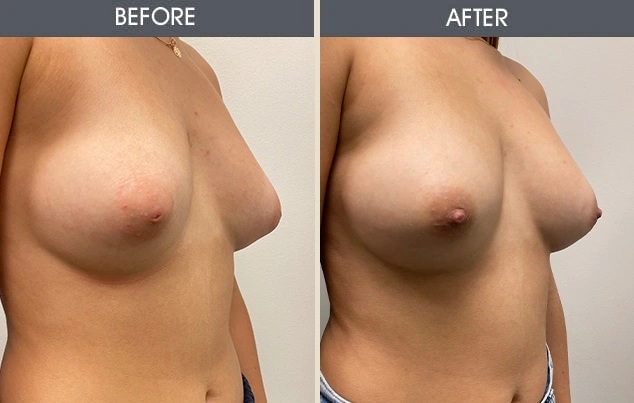Real patient results in New York, NY Performed by Darrick E. Antell MD, FACS