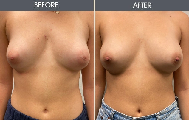 Real patient results in New York, NY Performed by Darrick E. Antell MD, FACS