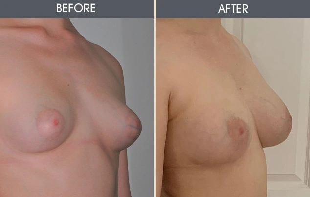 Real patient results in New York, NY Performed by Darrick E. Antell MD, FACS