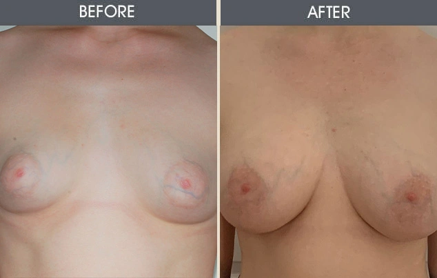 Real patient results in New York, NY Performed by Darrick E. Antell MD, FACS