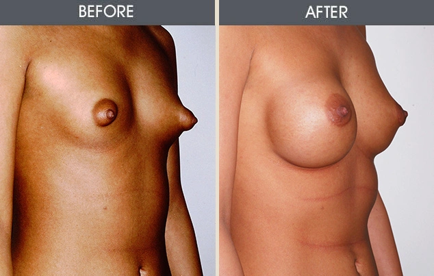 Real patient results in New York, NY Performed by Darrick E. Antell MD, FACS