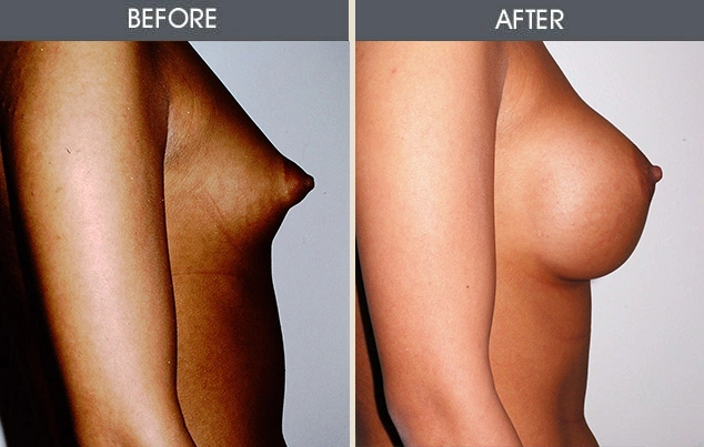 Real patient results in New York, NY Performed by Darrick E. Antell MD, FACS