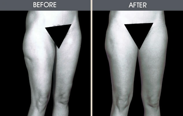 Real patient results in New York, NY Performed by Darrick E. Antell MD, FACS