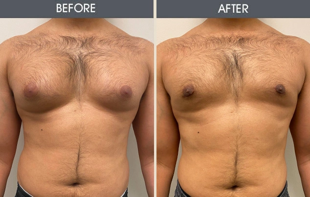 Real patient results in New York, NY Performed by Darrick E. Antell MD, FACS