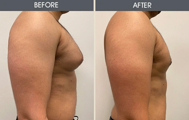 Real patient results in New York, NY Performed by Darrick E. Antell MD, FACS