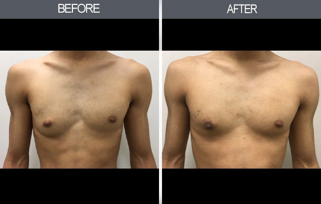 Real patient results in New York, NY Performed by Darrick E. Antell MD, FACS