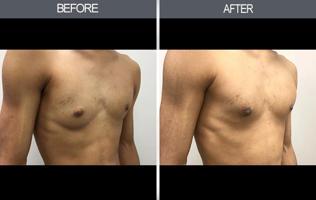 Real patient results in New York, NY Performed by Darrick E. Antell MD, FACS