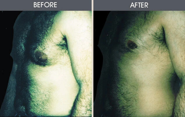 Real patient results in New York, NY Performed by Darrick E. Antell MD, FACS