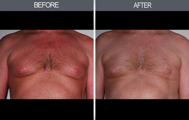 Real patient results in New York, NY Performed by Darrick E. Antell MD, FACS