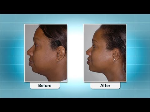 Before and after profile comparison showing cosmetic procedure results on woman's neck and jawline